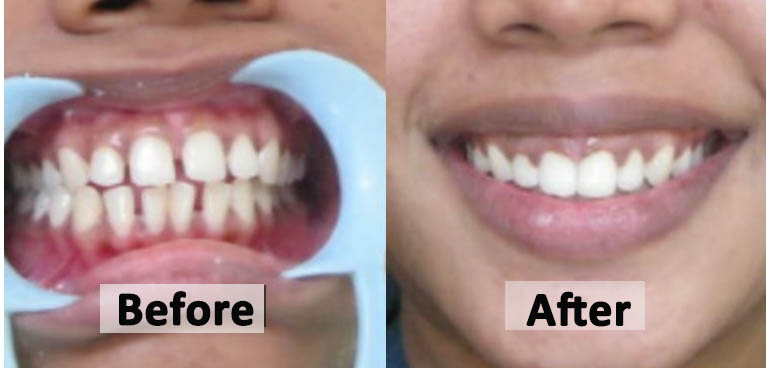 Dental Help Smiling Before After